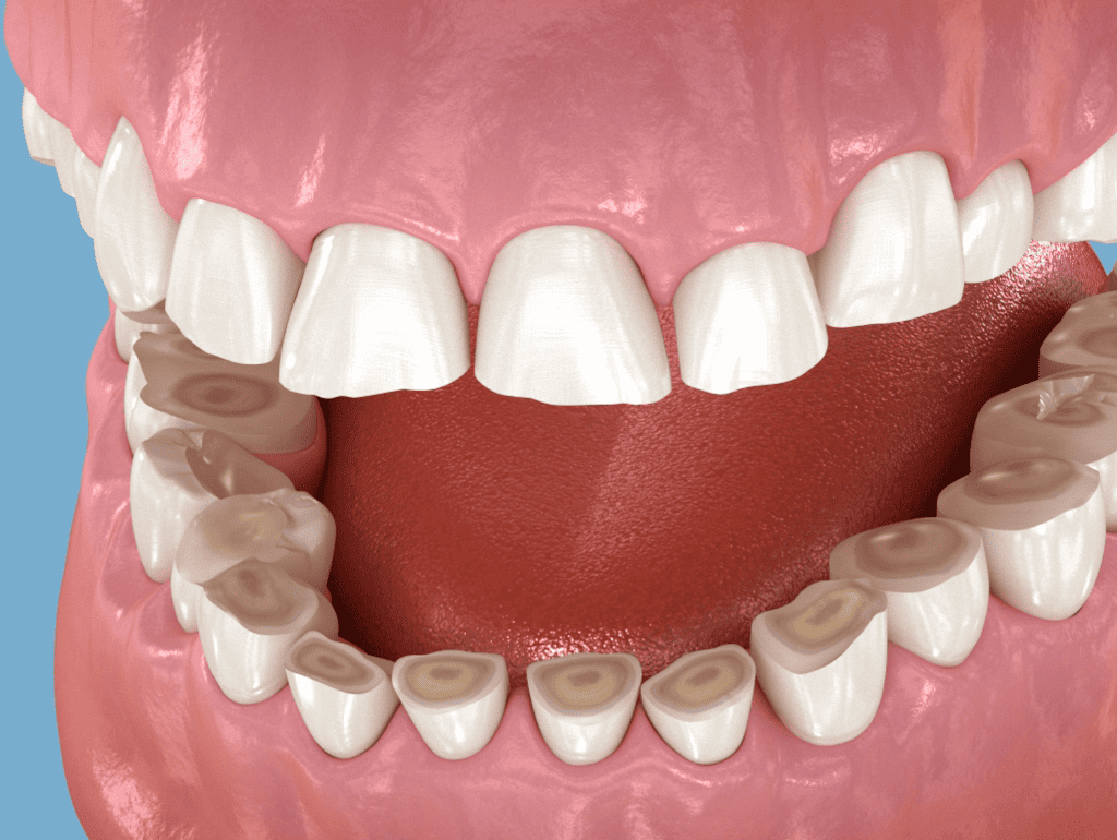 Bruxismo: cos'è e come curarlo