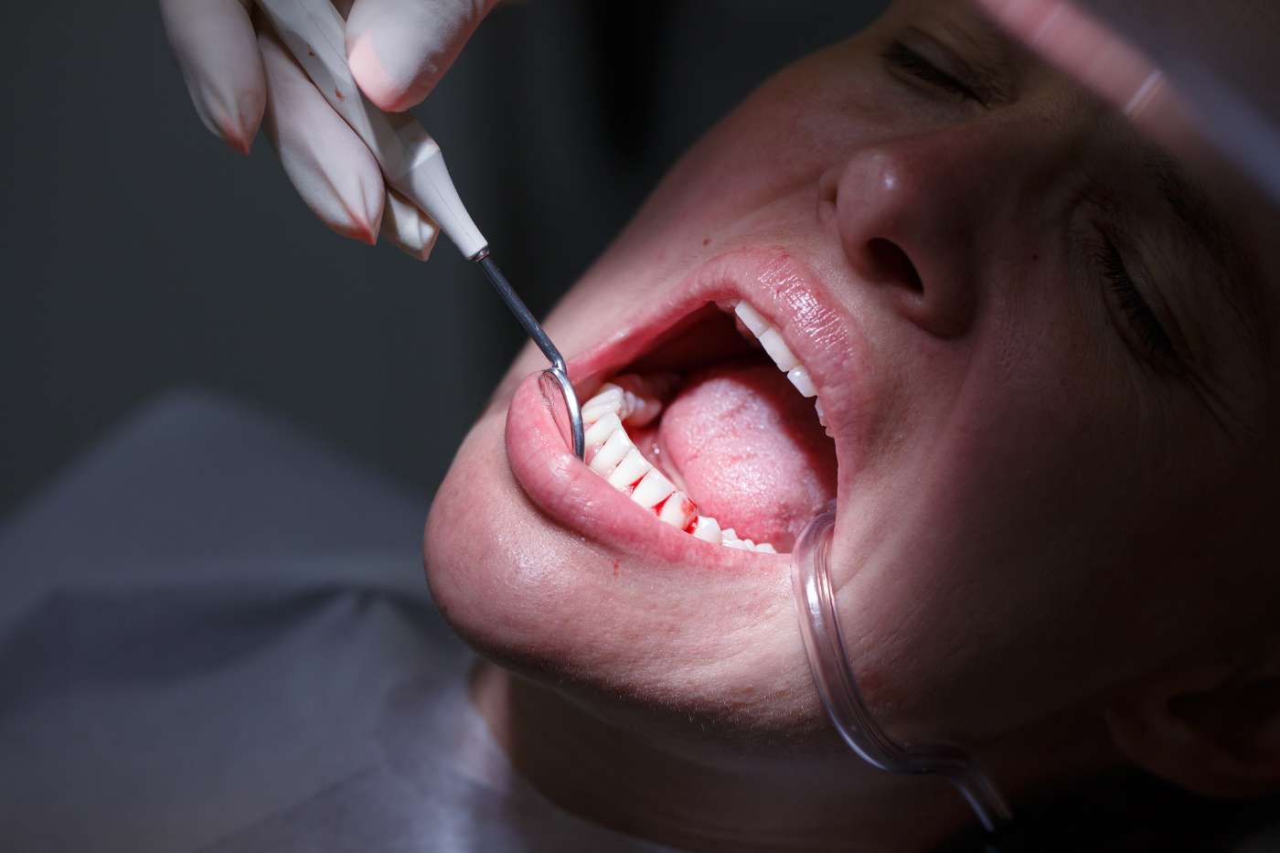 Prepararsi all'estrazione di un dente
