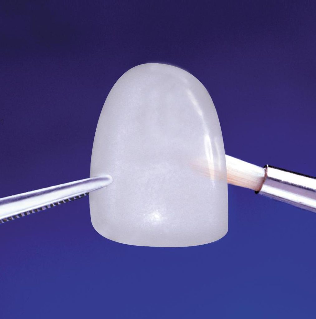 come si mettono le faccette dentali