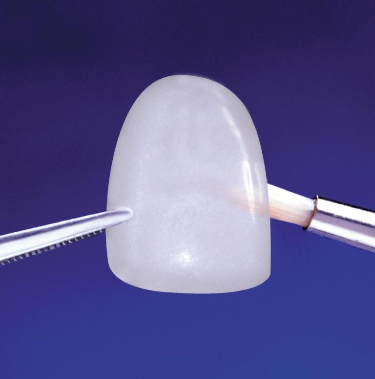 come si mettono le faccette dentali