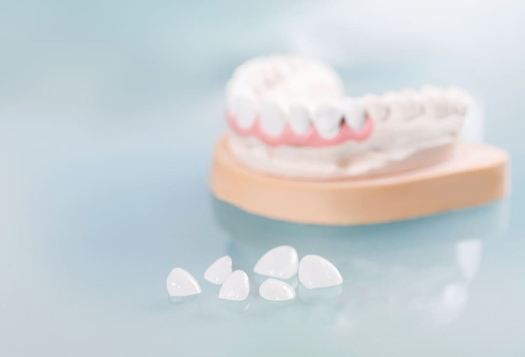 cosa sono le faccette dentali