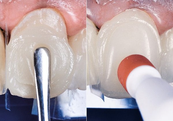 come si mettono le faccette dentali