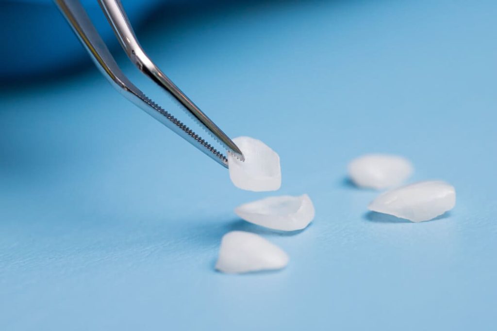 cosa sono le faccette dentali