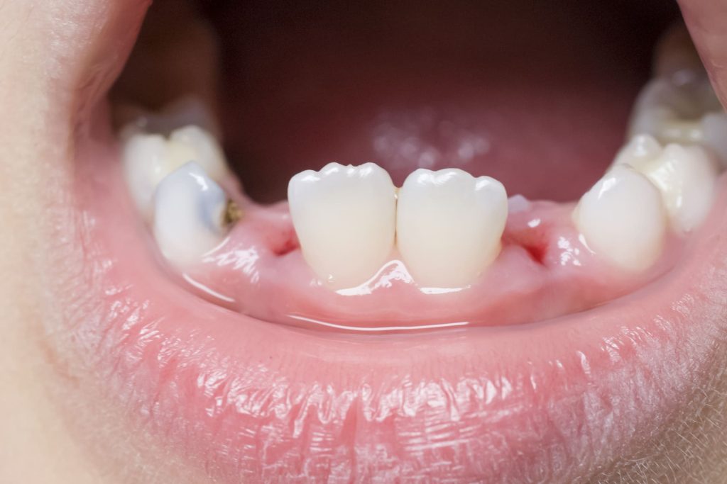 Quando cadono i denti da latte