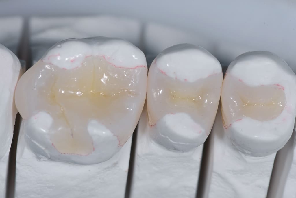 Intarsi dentali